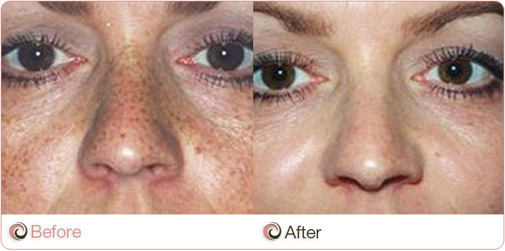 110311-COSCLI-before_and_after-laser-rejuvenation-5